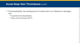 Copyright
©
2023
by
Jones
&
Bartlett
Learning,
LLC,
an
Ascend
Learning
Company
and
the
American
Academy
of
Orthopaedic
Surgeons.
Acute Deep Vein Thrombosis (1 of 7)
 Thrombophlebitis: the development of a blood clot in an inflamed or damaged
vein
 Superficial thrombophlebitis
 Deep vein thrombosis (DVT)
 