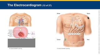 Copyright
©
2023
by
Jones
&
Bartlett
Learning,
LLC,
an
Ascend
Learning
Company
and
the
American
Academy
of
Orthopaedic
Surgeons.
The Electrocardiogram (12 of 27)
© Jones & Bartlett Learning. © Jones & Bartlett Learning
 