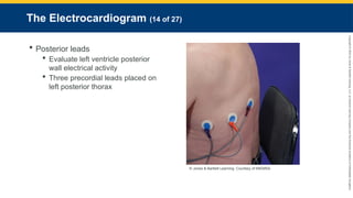 Copyright
©
2023
by
Jones
&
Bartlett
Learning,
LLC,
an
Ascend
Learning
Company
and
the
American
Academy
of
Orthopaedic
Surgeons.
The Electrocardiogram (14 of 27)
 Posterior leads
 Evaluate left ventricle posterior
wall electrical activity
 Three precordial leads placed on
left posterior thorax
© Jones & Bartlett Learning. Courtesy of MIEMSS.
 