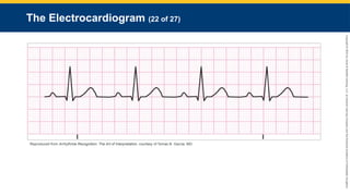 Copyright
©
2023
by
Jones
&
Bartlett
Learning,
LLC,
an
Ascend
Learning
Company
and
the
American
Academy
of
Orthopaedic
Surgeons.
The Electrocardiogram (22 of 27)
Reproduced from Arrhythmia Recognition: The Art of Interpretation, courtesy of Tomas B. Garcia, MD.
 