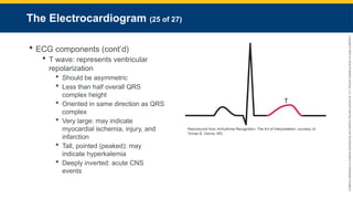 Copyright
©
2023
by
Jones
&
Bartlett
Learning,
LLC,
an
Ascend
Learning
Company
and
the
American
Academy
of
Orthopaedic
Surgeons.
The Electrocardiogram (25 of 27)
 ECG components (cont’d)
 T wave: represents ventricular
repolarization
 Should be asymmetric
 Less than half overall QRS
complex height
 Oriented in same direction as QRS
complex
 Very large: may indicate
myocardial ischemia, injury, and
infarction
 Tall, pointed (peaked): may
indicate hyperkalemia
 Deeply inverted: acute CNS
events
Reproduced from Arrhythmia Recognition: The Art of Interpretation, courtesy of
Tomas B. Garcia, MD.
 