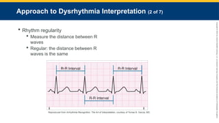 Copyright
©
2023
by
Jones
&
Bartlett
Learning,
LLC,
an
Ascend
Learning
Company
and
the
American
Academy
of
Orthopaedic
Surgeons.
Approach to Dysrhythmia Interpretation (2 of 7)
 Rhythm regularity
 Measure the distance between R
waves
 Regular: the distance between R
waves is the same
Reproduced from Arrhythmia Recognition: The Art of Interpretation, courtesy of Tomas B. Garcia, MD.
 