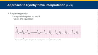 Copyright
©
2023
by
Jones
&
Bartlett
Learning,
LLC,
an
Ascend
Learning
Company
and
the
American
Academy
of
Orthopaedic
Surgeons.
Approach to Dysrhythmia Interpretation (3 of 7)
 Rhythm regularity
 Irregularly irregular: no two R
waves are equidistant
Reproduced from Arrhythmia Recognition: The Art of Interpretation, courtesy of Tomas B. Garcia, MD.
 