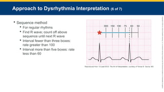 Copyright
©
2023
by
Jones
&
Bartlett
Learning,
LLC,
an
Ascend
Learning
Company
and
the
American
Academy
of
Orthopaedic
Surgeons.
Approach to Dysrhythmia Interpretation (6 of 7)
 Sequence method
 For regular rhythms
 Find R wave; count off above
sequence until next R wave
 Interval fewer than three boxes:
rate greater than 100
 Interval more than five boxes: rate
less than 60
Reproduced from 12-Lead ECG: The Art of Interpretation, courtesy of Tomas B. Garcia, MD.
 
