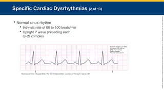 Copyright
©
2023
by
Jones
&
Bartlett
Learning,
LLC,
an
Ascend
Learning
Company
and
the
American
Academy
of
Orthopaedic
Surgeons.
Specific Cardiac Dysrhythmias (2 of 13)
 Normal sinus rhythm
 Intrinsic rate of 60 to 100 beats/min
 Upright P wave preceding each
QRS complex
Reproduced from 12-Lead ECG: The Art of Interpretation, courtesy of Tomas B. Garcia, MD.
 