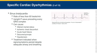 Copyright
©
2023
by
Jones
&
Bartlett
Learning,
LLC,
an
Ascend
Learning
Company
and
the
American
Academy
of
Orthopaedic
Surgeons.
Specific Cardiac Dysrhythmias (3 of 13)
 Sinus bradycardia
 Rate of less than 60 beats/min
 Upright P wave preceding every
QRS complex
 Can cause:
 Altered mental status
 Ischemic chest discomfort
 Acute heart failure
 Seizures/syncope
 Hypotension
 Treatment indicated when
signs/symptoms persist despite
adequate airway and breathing
Reproduced from Arrhythmia Recognition: The Art of Interpretation,
courtesy of Tomas B. Garcia, MD.
 