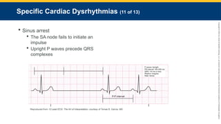 Copyright
©
2023
by
Jones
&
Bartlett
Learning,
LLC,
an
Ascend
Learning
Company
and
the
American
Academy
of
Orthopaedic
Surgeons.
Specific Cardiac Dysrhythmias (11 of 13)
 Sinus arrest
 The SA node fails to initiate an
impulse
 Upright P waves precede QRS
complexes
Reproduced from 12-Lead ECG: The Art of Interpretation, courtesy of Tomas B. Garcia, MD.
 