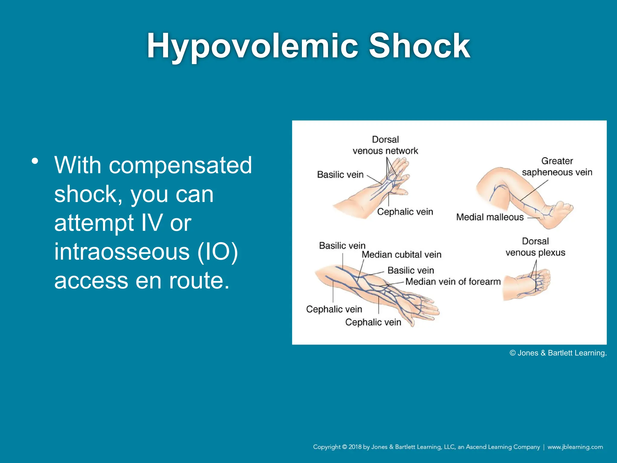 Hypovolemic Shock
• With compensated
shock, you can
attempt IV or
intraosseous (IO)
access en route.
© Jones & Bartlett Learning.
 