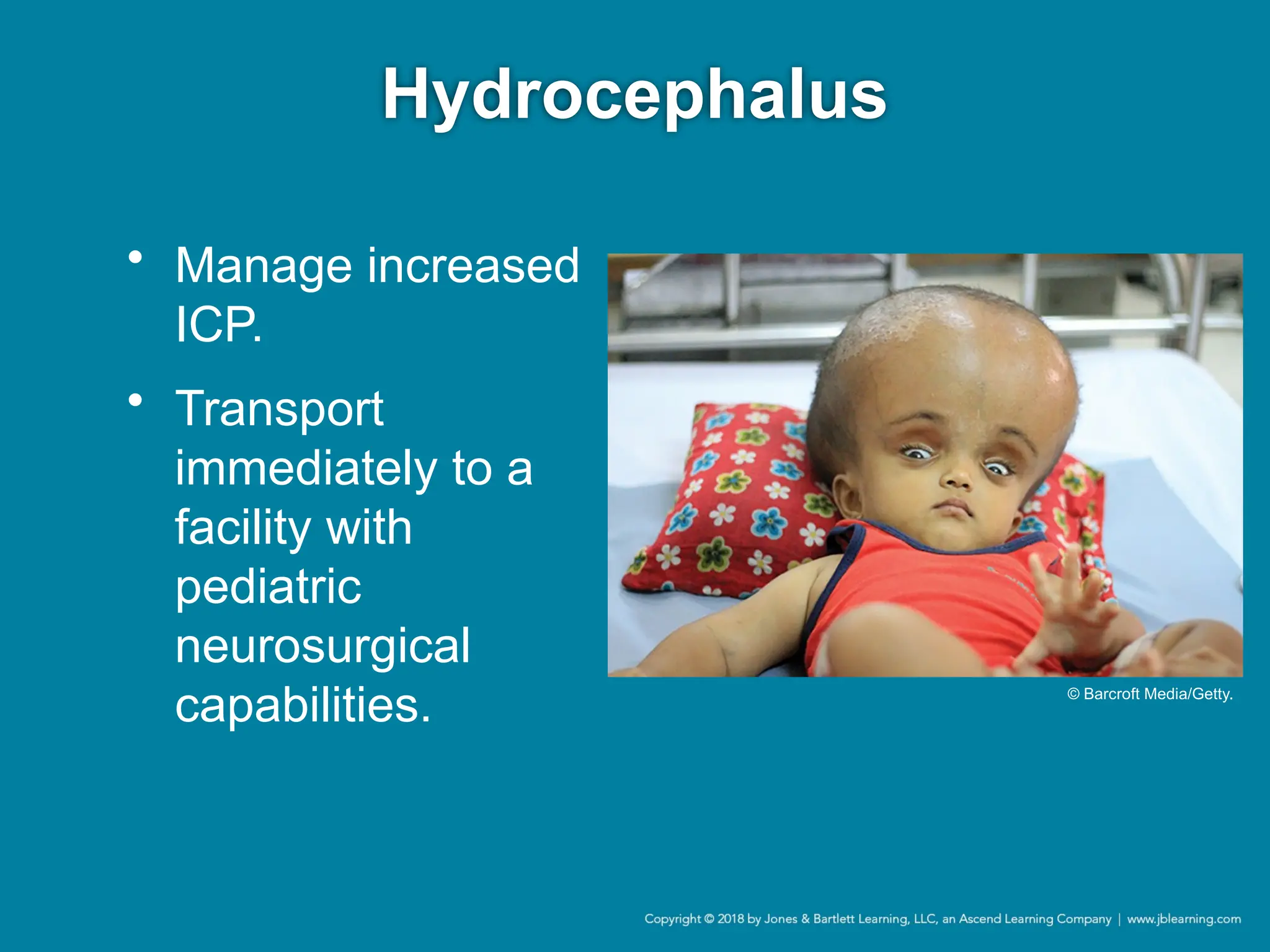 Hydrocephalus
• Manage increased
ICP.
• Transport
immediately to a
facility with
pediatric
neurosurgical
capabilities. © Barcroft Media/Getty.
 