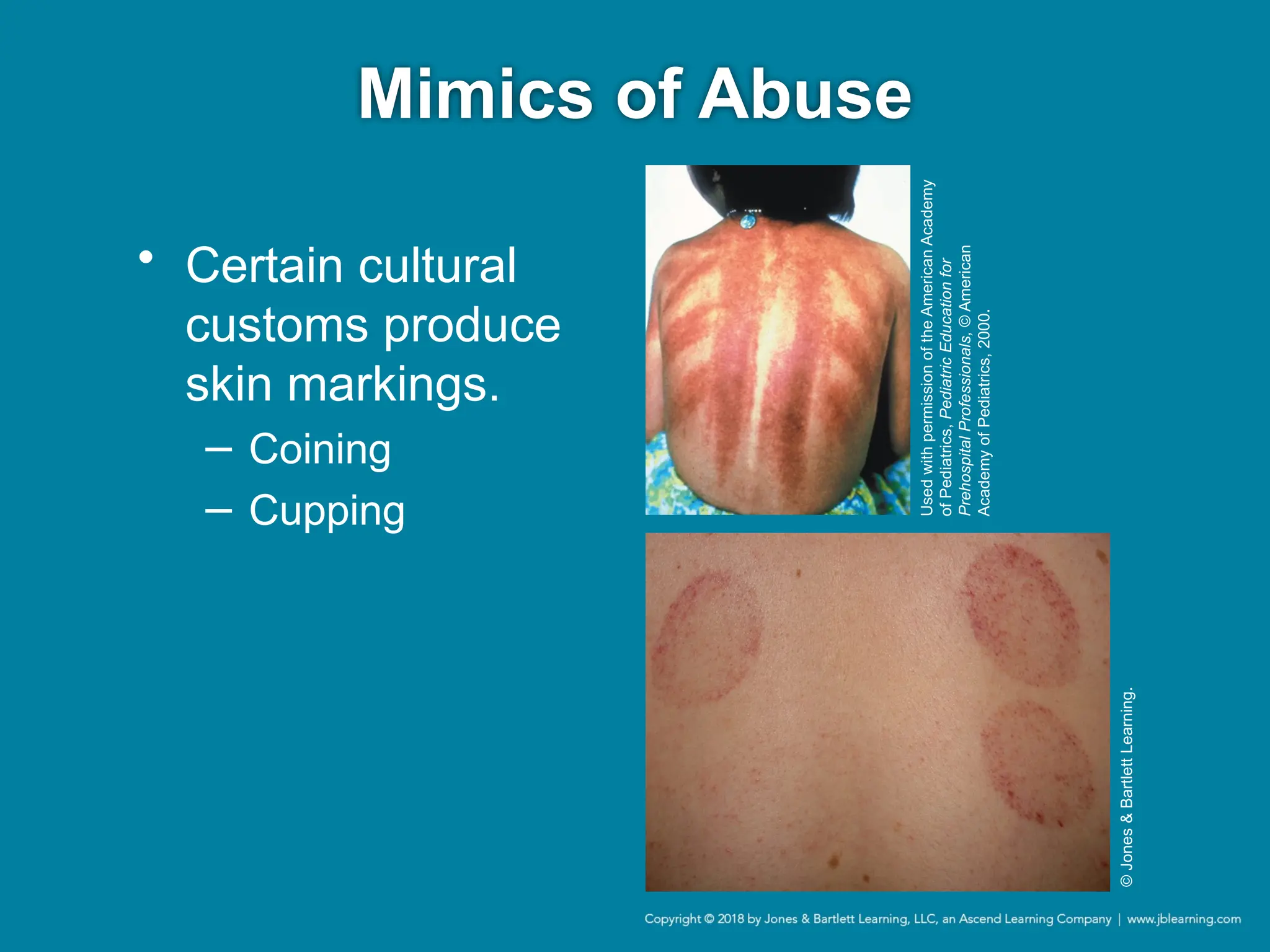 Mimics of Abuse
• Certain cultural
customs produce
skin markings.
− Coining
− Cupping
Used
with
permission
of
the
American
Academy
of
Pediatrics,
Pediatric
Education
for
Prehospital
Professionals,
©
American
Academy
of
Pediatrics,
2000.
©
Jones
&
Bartlett
Learning.
 