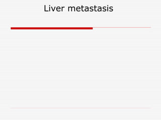 Liver metastasis
 