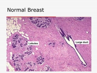 Normal Breast
Large duct
Lobules
 