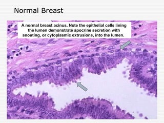 Normal Breast
A normal breast acinus. Note the epithelial cells lining
the lumen demonstrate apocrine secretion with
snouting, or cytoplasmic extrusions, into the lumen.
 