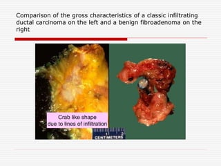 Comparison of the gross characteristics of a classic infiltrating
ductal carcinoma on the left and a benign fibroadenoma on the
right
Crab like shape
due to lines of infiltration
 