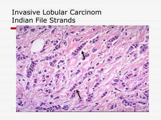 Invasive Lobular Carcinom
Indian File Strands
 