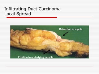 Infiltrating Duct Carcinoma
Local Spread
Retraction of nipple
Fixation to underlying muscle
 