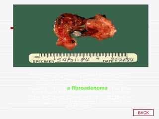 Here is a surgical excision of a small mass
from the breast. The mass is well-
circumscribed. Grossly it felt firm and
rubbery. This is a fibroadenoma. The blue
dye around the fibroadenoma was used to
mark the lesion during needle localization in
radiology so that the surgeon could find this
small mass .
BACK
 
