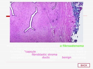 Here is the microscopic appearance of a fibroadenoma.
To the right is compressed breast connective tissue
forming a "capsule" to this mass. The neoplasm itself is
composed of a fibroblastic stroma in which are located
elongated compressed ducts lined by benign appearing
epithelium
BACK
 