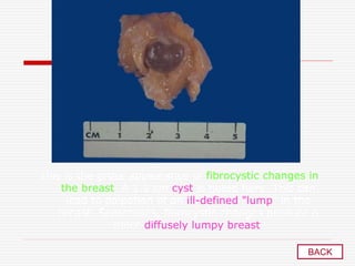 This is the gross appearance of fibrocystic changes in
the breast. A 1.5 cm cyst is noted here. This can
lead to palpation of an ill-defined "lump" in the
breast. Sometimes, fibrocystic changes produce a
more diffusely lumpy breast.
BACK
 