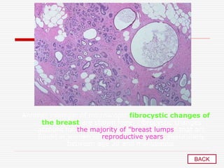 Another example of microscopic fibrocystic changes of
the breast are shown here. Fibrocystic changes
account for the majority of "breast lumps" that are
found in women of reproductive years, particularly
between age 30 and menopause.
BACK
 