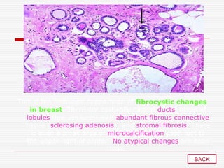 This is the histologic appearance of fibrocystic changes
in breast. There are cystically dilated ducts, areas of
lobules that are laced with abundant fibrous connective
tissue (sclerosing adenosis), and stromal fibrosis. There
is even a small area of microcalcification seen just to
the upper right of center. No atypical changes are seen
here
BACK
 