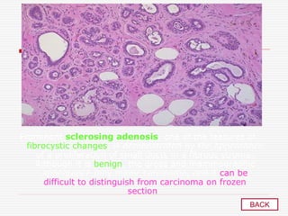 Prominent sclerosing adenosis, one of the features of
fibrocystic changes, is demonstrated by the appearance
of a proliferation of small ducts in a fibrous stroma.
Although it is benign, the gross and mammographic
appearance may mimic carcinoma, and it can be
difficult to distinguish from carcinoma on frozen
section .
BACK
 
