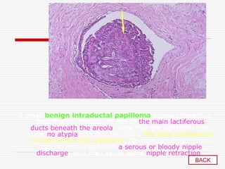A small benign intraductal papilloma appears here in a
breast duct, typically in one of the main lactiferous
ducts beneath the areola. Note that the epithelial cells
show no atypia and that there is a fine pink collagenous
stroma within the papilloma. An intraductal papilloma
may be associated with a serous or bloody nipple
discharge, or it may cause some nipple retraction .
BACK
 