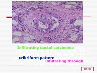 Infiltrating ductal carcinoma, the
pleomorphism of the carcinoma cells
within the duct in the center (in a
cribriform pattern), as well as the
neoplastic cells infiltrating through the
stroma and fat, can be seen
BACK
 
