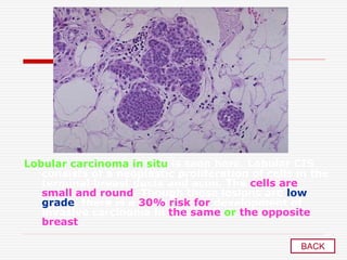 Lobular carcinoma in situ is seen here. Lobular CIS
consists of a neoplastic proliferation of cells in the
terminal breast ducts and acini. The cells are
small and round. Though these lesions are low
grade, there is a 30% risk for development of
invasive carcinoma in the same or the opposite
breast .
BACK
 