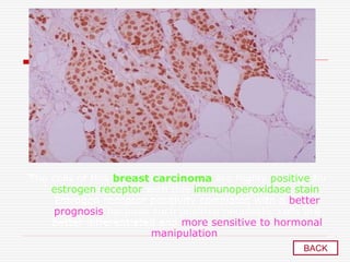 The cells of this breast carcinoma are highly positive for
estrogen receptor with this immunoperoxidase stain.
Estrogen receptor positivity correlates with a better
prognosis because such positive neoplastic cells are
better differentiated and more sensitive to hormonal
manipulation .
BACK
 