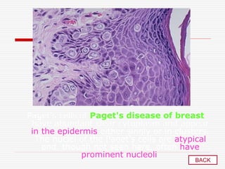 Paget's cells of Paget's disease of breast
have abundant clear cytoplasm and appear
in the epidermis either singly or in clusters.
The nuclei of the Paget's cells are atypical
and, though not seen here, often have
prominent nucleoli
BACK
 