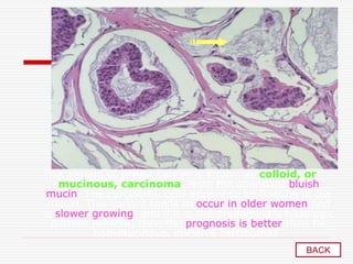 This variant of breast cancer is known as colloid, or
mucinous, carcinoma. Note the abundant bluish
mucin. The carcinoma cells appear to be floating in the
mucin. This variant tends to occur in older women and
is slower growing, and if it is the predominant histologic
pattern present, then the prognosis is better than for
non-mucinous, invasive carcinomas .
BACK
 