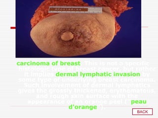 carcinoma of breast. This is not a specific
histologic type of breast cancer, but rather
it implies dermal lymphatic invasion by
some type of underlying breast carcinoma.
Such involvement of dermal lymphatics
gives the grossly thickened, erythematous,
and rough skin surface with the
appearance of an orange peel ("peau
d'orange").
BACK
 