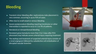 984. Percutaneous Nephrostomy (1).pptxedrrrrrrrr | PPTX
