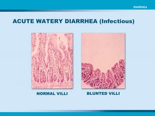 NORMAL VILLI BLUNTED VILLI ACUTE WATERY DIARRHEA (Infectious)  DIARRHEA 