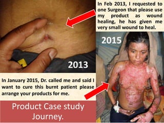 Product Case study
Journey.
2013
2015
In Feb 2013, I requested to
one Surgeon that please use
my product as wound
healing, he has given me
very small wound to heal.
In January 2015, Dr. called me and said I
want to cure this burnt patient please
arrange your products for me.
 