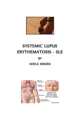 SYSTEMIC LUPUS
ERYTHEMATOSIS - SLE
BY
ADELE KRIZEK
 