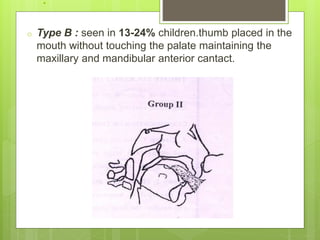 .
o Type B : seen in 13-24% children.thumb placed in the
mouth without touching the palate maintaining the
maxillary and mandibular anterior cantact.
 