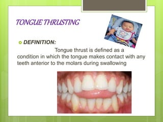TONGUETHRUSTING
 DEFINITION:
Tongue thrust is defined as a
condition in which the tongue makes contact with any
teeth anterior to the molars during swallowing
 