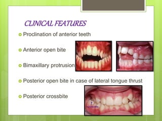 CLINICALFEATURES
 Proclination of anterior teeth
 Anterior open bite
 Bimaxillary protrusion
 Posterior open bite in case of lateral tongue thrust
 Posterior crossbite
 