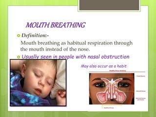 MOUTHBREATHING
 Definition:-
Mouth breathing as habitual respiration through
the mouth instead of the nose.
 Usually seen in people with nasal obstruction
May also occur as a habit
 