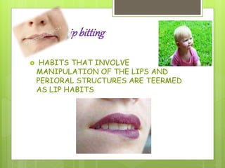 Lipbitting
 HABITS THAT INVOLVE
MANIPULATION OF THE LIPS AND
PERIORAL STRUCTURES ARE TEERMED
AS LIP HABITS
 