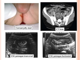 10
USG potongan tranversal USG potongan horizontal
CT Scan
Currant jelly stool
 
