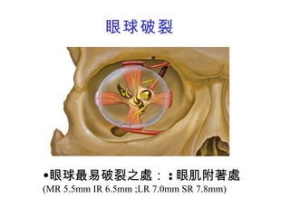 眼球最易破裂之處： : 眼肌附著處 (MR 5.5mm IR 6.5mm ;LR 7.0mm SR 7.8mm) 眼球破裂 