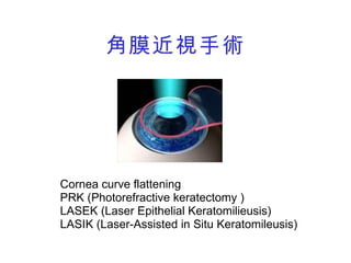 角膜近視手術 Cornea curve flattening PRK (Photorefractive keratectomy ) LASEK (Laser Epithelial Keratomilieusis)  LASIK (Laser-Assisted in Situ Keratomileusis) 