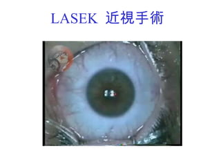 LASEK  近視手術 