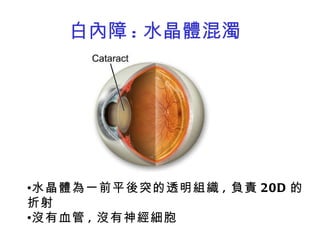 白內障 : 水晶體混濁 水晶體為一前平後突的透明組織 , 負責 20D 的折射 沒有血管 , 沒有神經細胞 