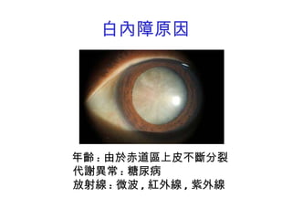 白內障原因 年齡 : 由於赤道區上皮不斷分裂 代謝異常 : 糖尿病 放射線 : 微波 , 紅外線 , 紫外線 