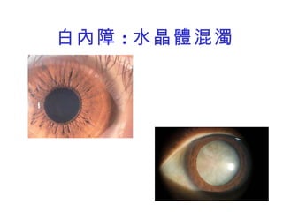 白內障 : 水晶體混濁 
