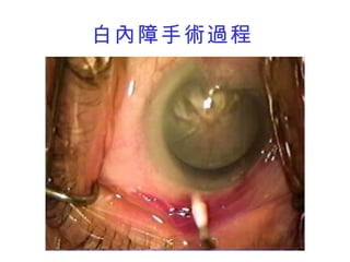 白內障手術過程 